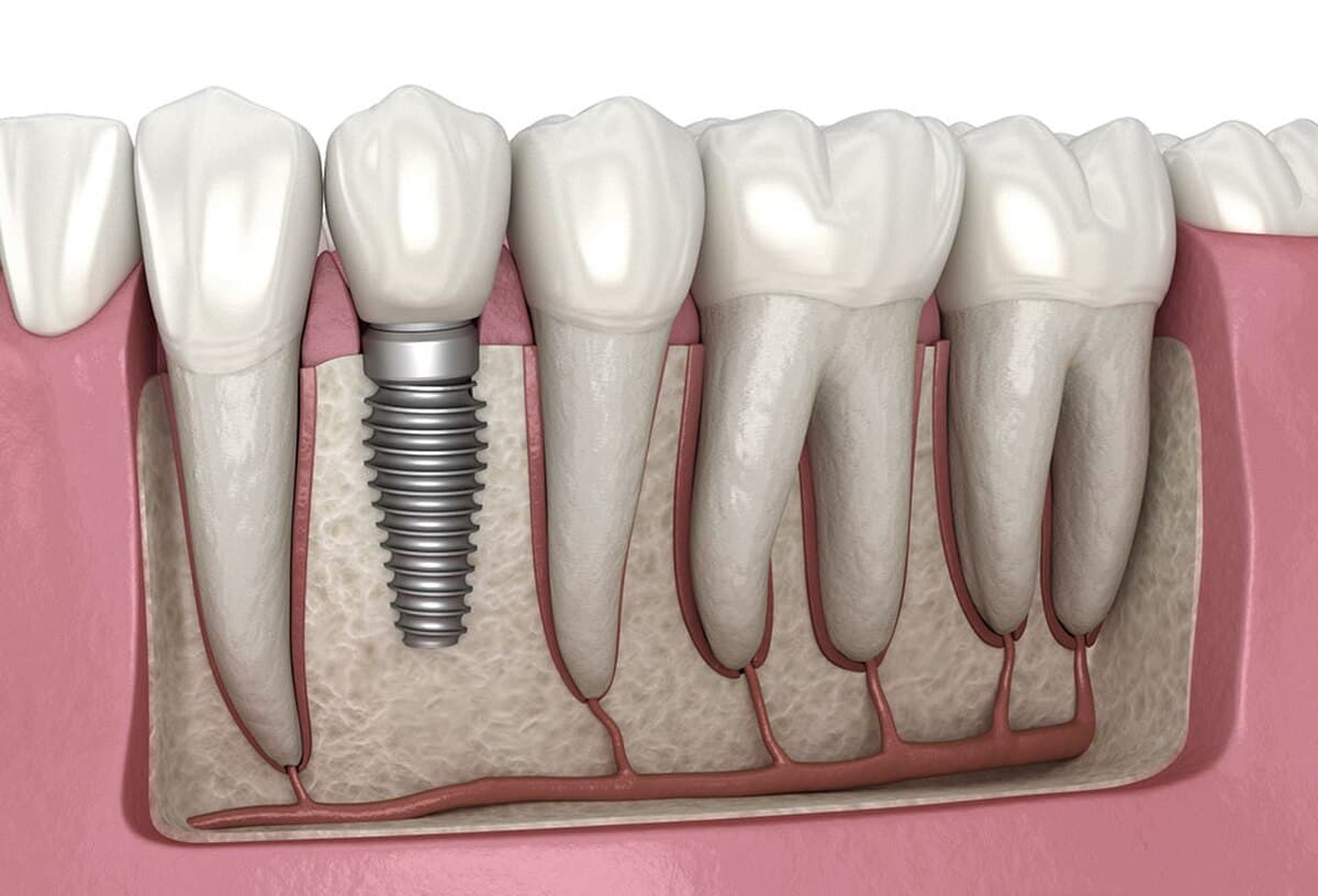 Illustration d'un implant dentaire en titane