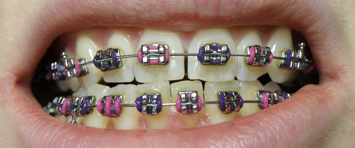 Traitement orthodontique avec brackets et fil metallique