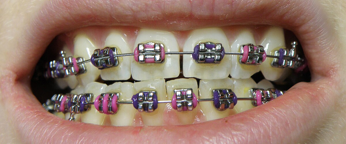 Traitement orthodontique avec brackets et fil metallique